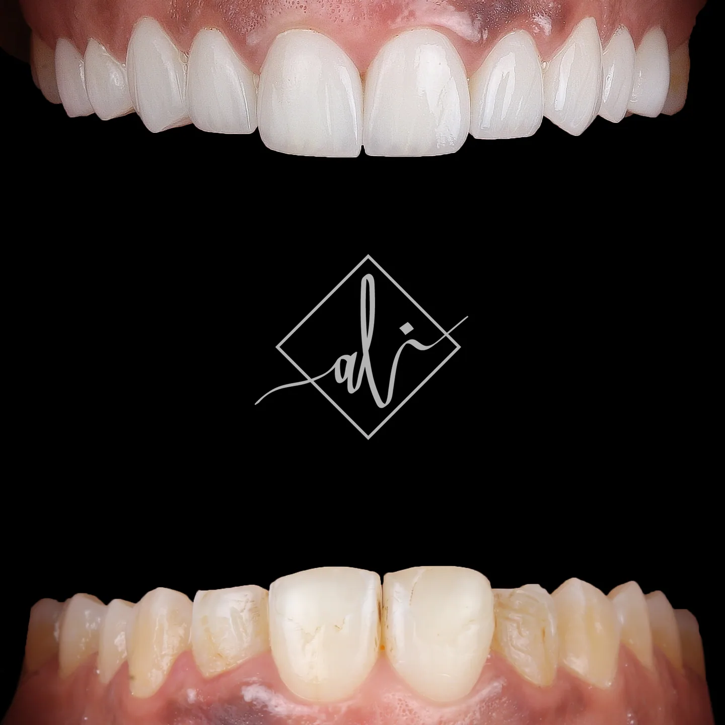 Natural smile upgrade before and after dental result 2