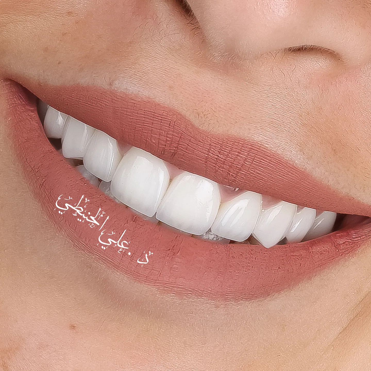 Natural smile upgrade before and after dental result 3