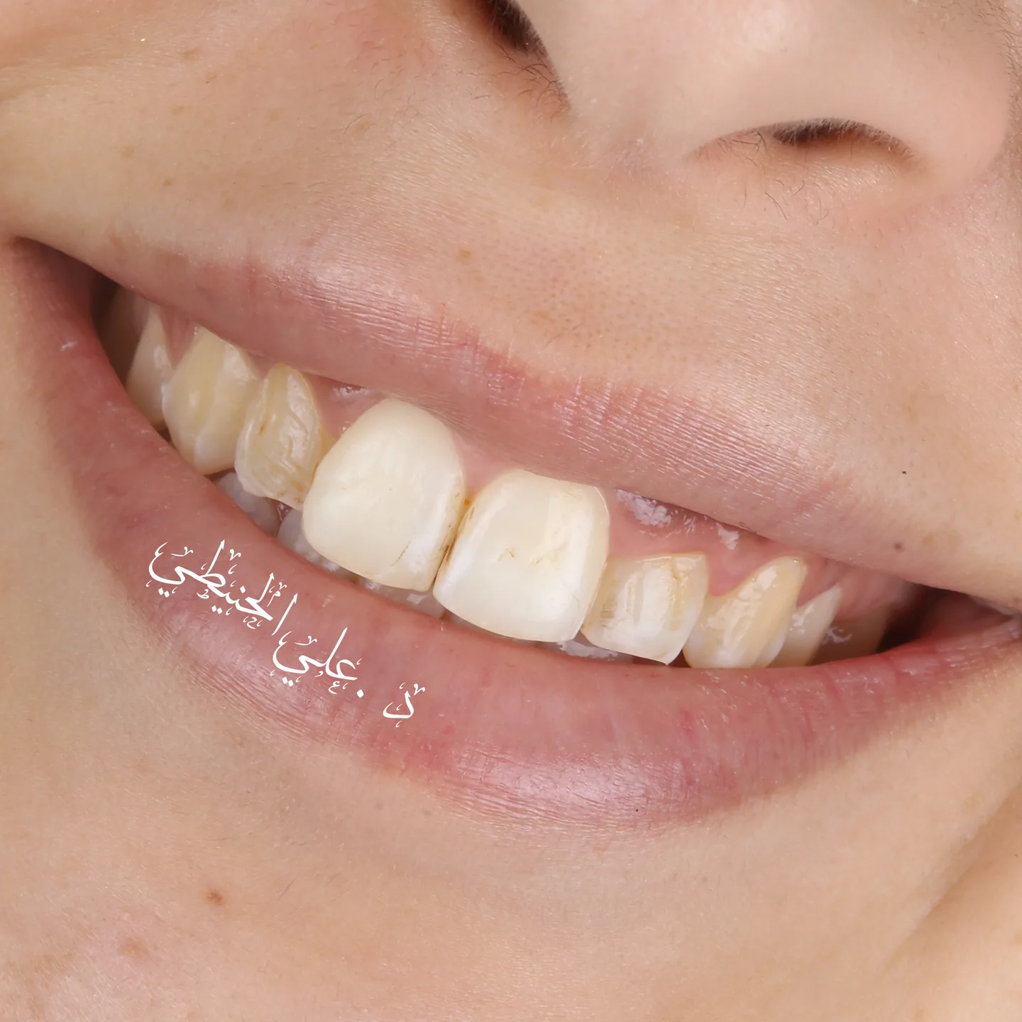 Natural smile upgrade before and after dental result 4